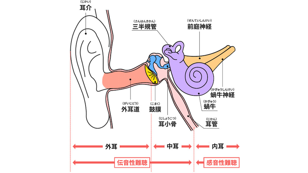 難聴によるストレスと症状とは？当事者の4つの対策方法