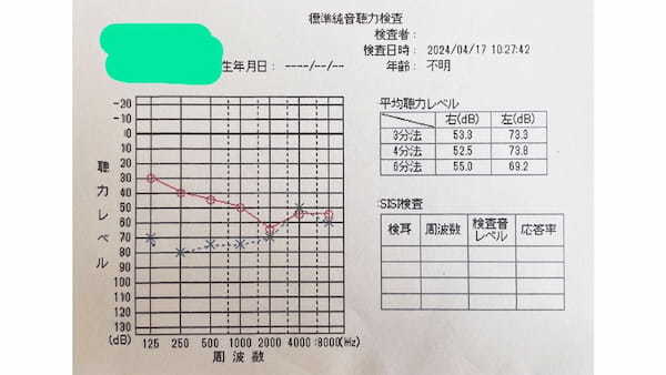 難聴によるストレスと症状とは？当事者の4つの対策方法